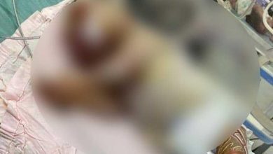 صورة “طفل الشمع”.. حالة ولادة نادرة في مستشفى المحلة