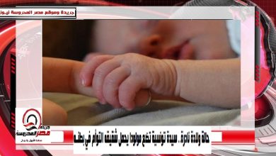 صورة حالة ولادة نادرة.. سيدة تونسية تضع مولودا يحمل شقيقه التوأم في بطنه